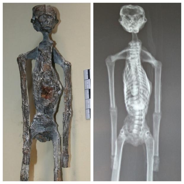 X-ray tests were done showing the artificial union of the bones, and that these had no joints.  (Photo: Courtesy of Flavio EstradaI)