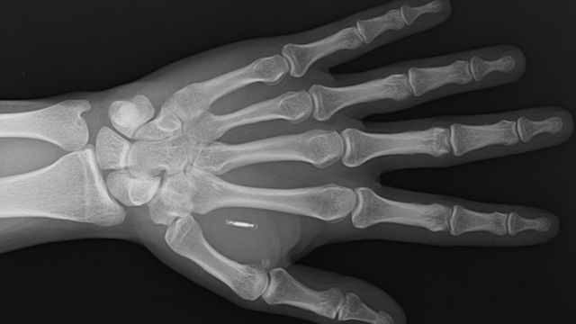 X-ray image of the hand showing the Walletmor implant