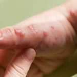Belgium orders 3-week isolation of monkeypox