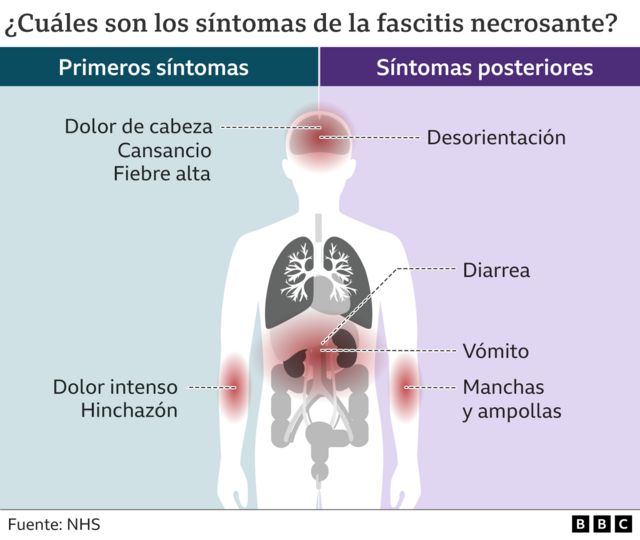 Symptoms of necrotizing fasciitis.